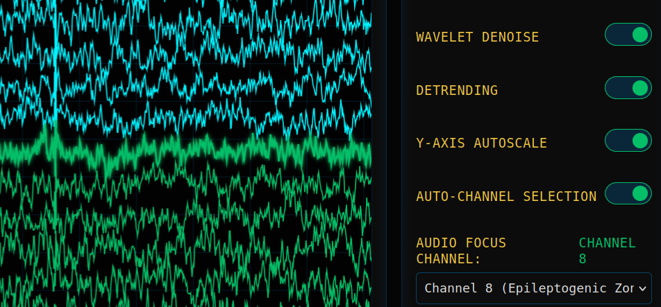 iEEG Multi-Channel Stack Visualization - Interactive Clinical Analysis Lab