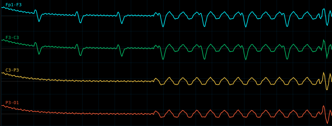 EEG Signal Artifacts & Epileptiform Pattern Visualizer - Interactive Laboratory